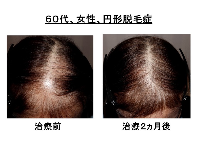 円形脱毛症　病院